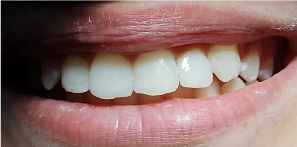 Tratamiento de ortodoncia 2 - After