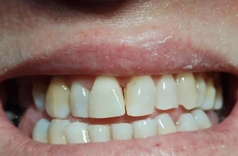 Tratamiento de ortodoncia 4 - After